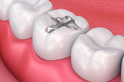 An image featuring a close-up view of a dental implant surrounded by artificial teeth, set against a pinkish background that resembles gum tissue.