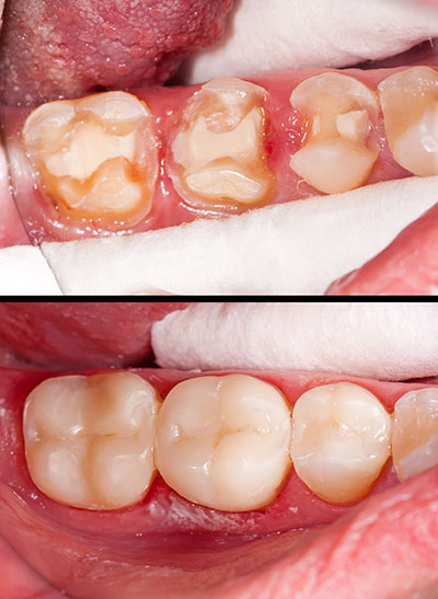 The image shows a close-up of an open mouth with teeth that appear to be in the process of being repaired or replaced, possibly during dental treatment.