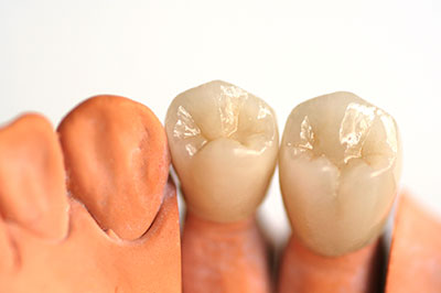 Dental implants with a focus on the lower jaw, showcasing a side-by-side comparison of an artificial tooth and natural teeth.