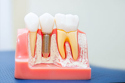 The image displays a model of a human mouth with artificial teeth and gums, showcasing the dental implantation process.