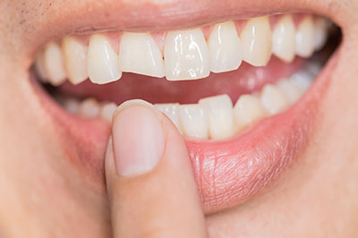 The image shows a close-up of a person s smiling mouth with teeth, and their hand is holding a finger in front of the teeth.