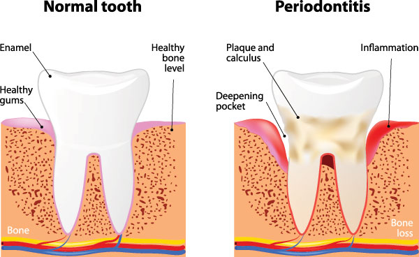 The image is a medical educational diagram illustrating the stages of gum disease progression from normal to periodontitis, with labels indicating healthy bone, inflammation, and bone loss.