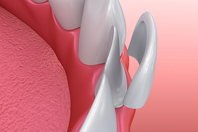 The image displays a close-up of a human mouth with a focus on the teeth, featuring a pink tongue and a partial view of the gums.