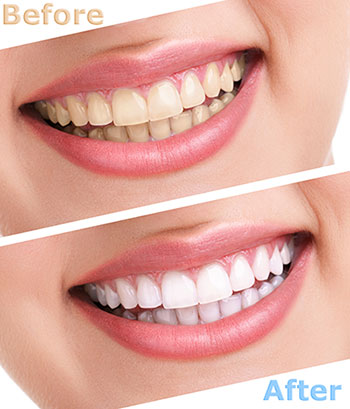 The image shows a series of three photographs of a person s smile, each depicting a different stage of teeth whitening.