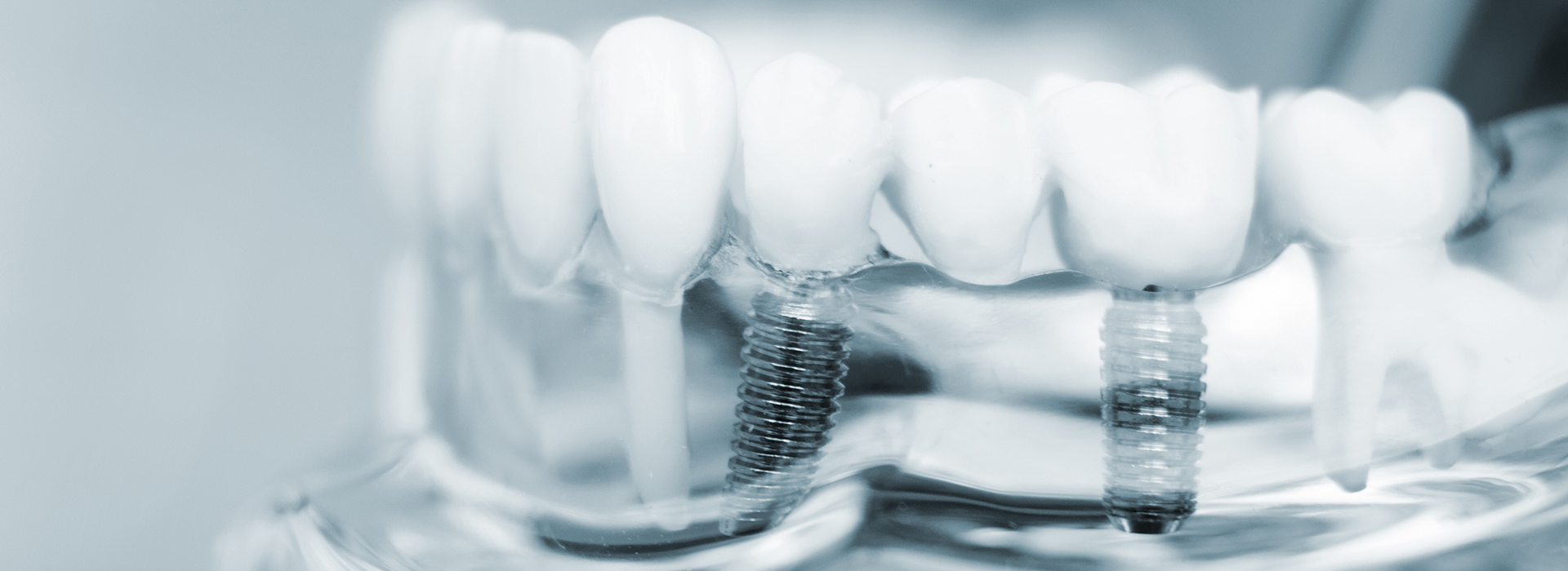 The image shows a close-up of a dental implant with screws and components, likely for an educational or informational purpose.